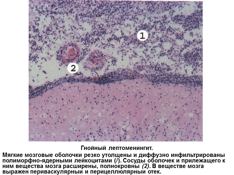 Гнойный лептоменингит. Мягкие мозговые оболочки резко утолщены и диффузно инфильтрированы полиморфно-ядерными лейкоцитами (/). Сосуды